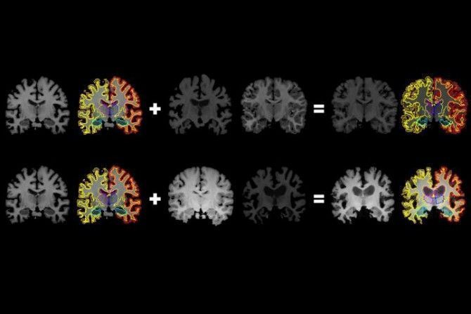 Desde un escáner cerebral, más información para inteligencia artificial médica.