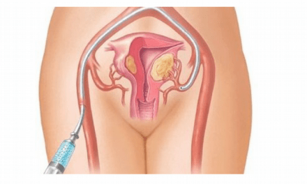 Embolización de fibromas, un procedimiento mínimamente invasivo