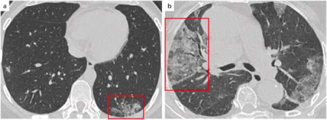 Inteligencia artificial para detectar lesiones pulmonares causadas por la COVID-19