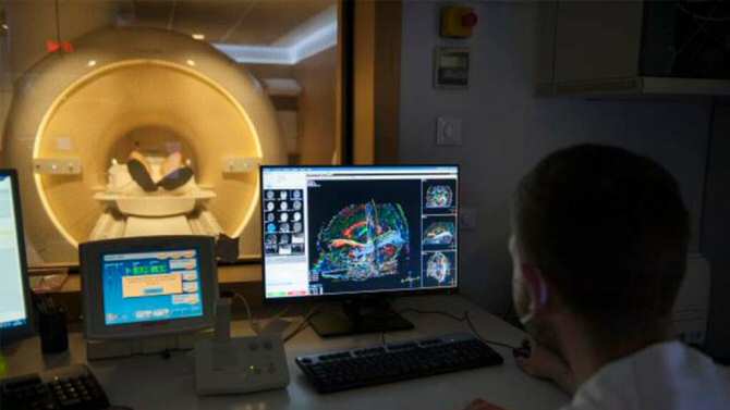 Extirpar tumores cerebrales preservando mejor un área del lenguaje