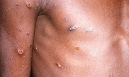Sanidad informa de la segunda muerte por la viruela del mono en España
