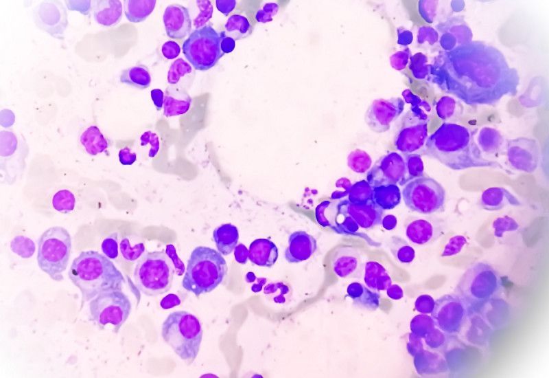 Terapias innovadoras aumentan sobrevida de pacientes con mieloma múltiple