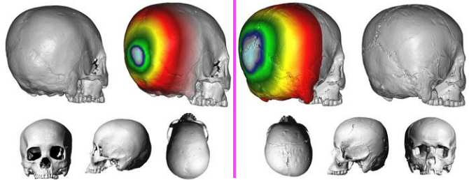 Modificación artificial de cráneos de humanos vivos hace más de mil años