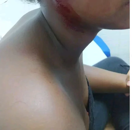 Niña de 11 años desfigura la cara a otra de su misma edad en el km 28, Pedro Brand