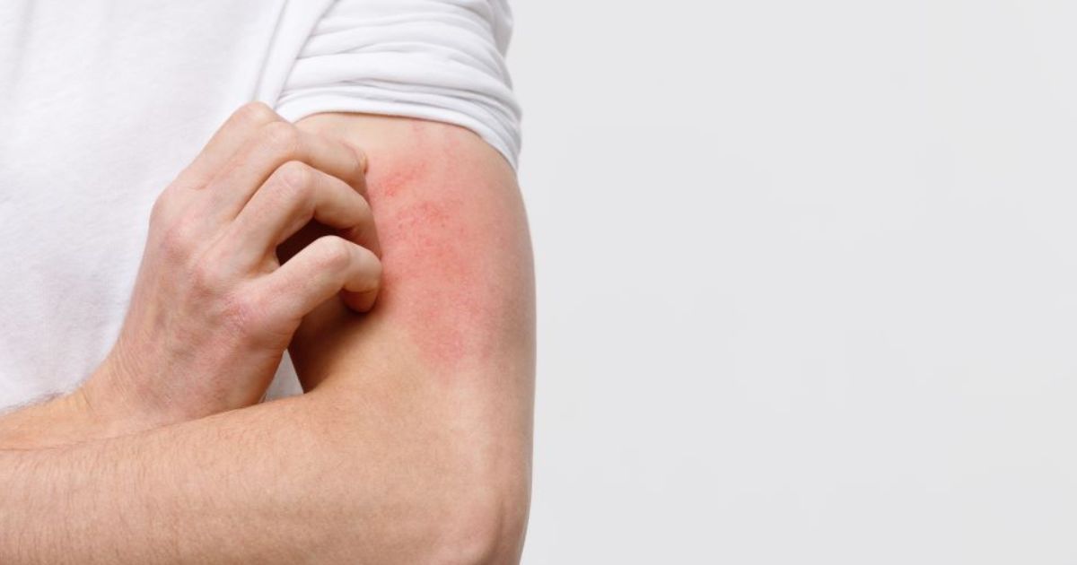 Estrés desencadena y mantiene dermatitis atópica hasta en un 50% de los pacientes