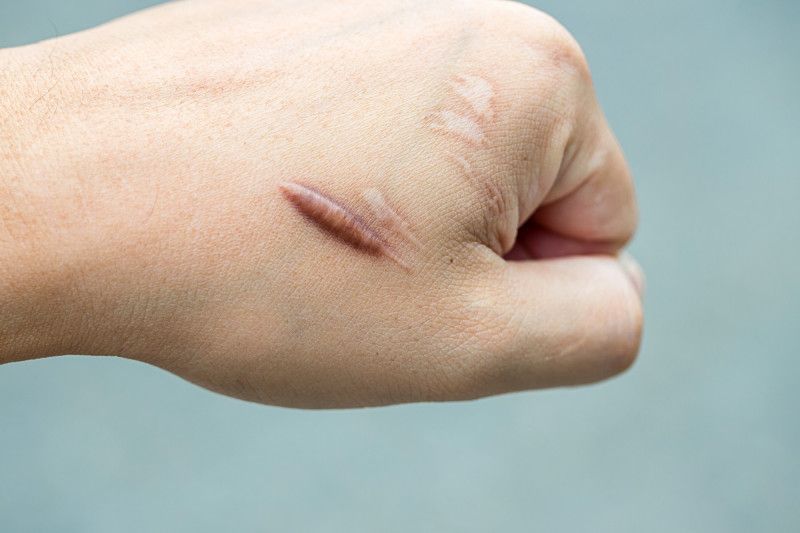 Queloides, exceso de piel en una cicatriz