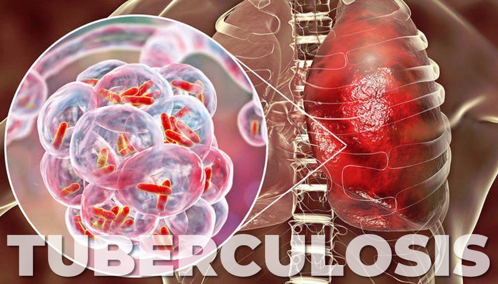 Revelan tuberculosis multirresistente sigue siendo una crisis de salud pública