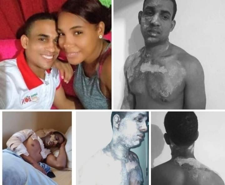 Mujer le lanza agua caliente a su expareja en San Cristóbal; resultó con graves quemaduras