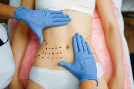 Cirujana plástica advierte sobre los riesgos que pudiera causar la abdominoplastía