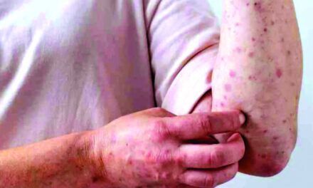 OMS declara la viruela del mono como emergencia internacional de salud pública