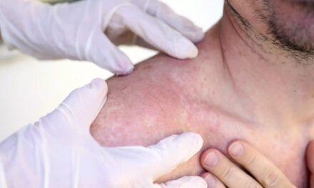 El Instituto Dermatológico detecta 266 casos de cáncer de piel en dos meses