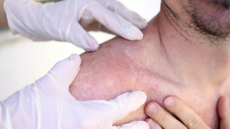 El Instituto Dermatológico detecta 266 casos de cáncer de piel en dos meses