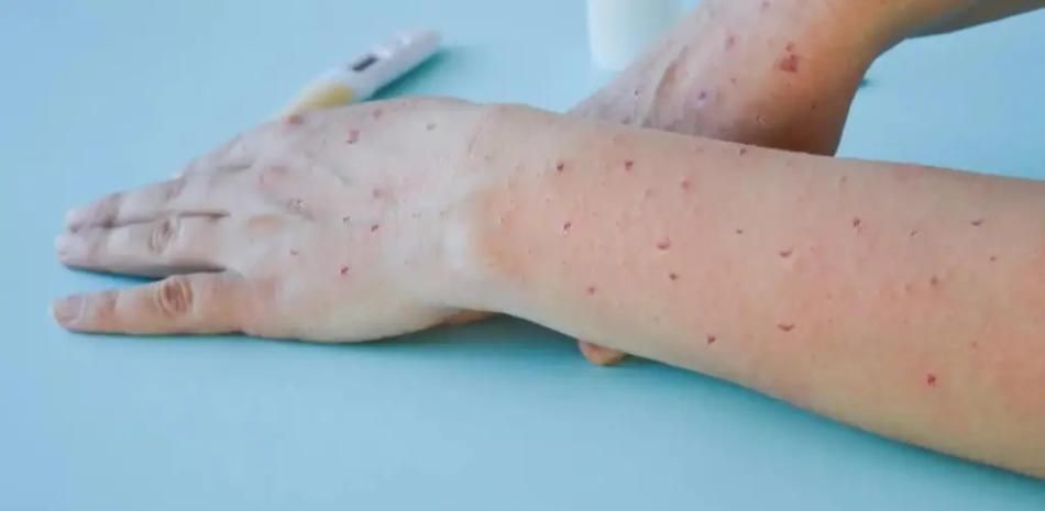 Salud Pública fortalece vigilancia epidemiológica tras declaración OMS por viruela del mono