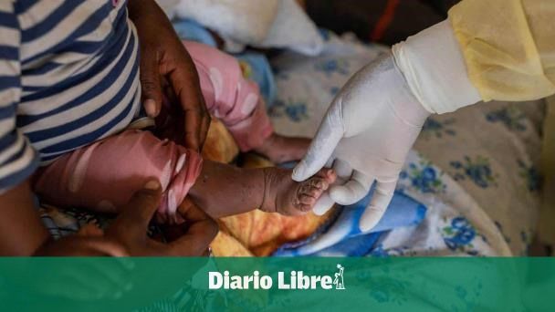 España vigila la nueva variante del mpox y recomienda vacuna
