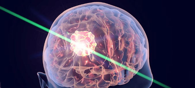 Desarrollan una linterna molecular para detectar metástasis en el cerebro