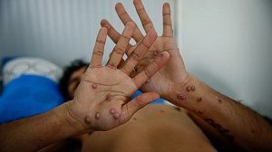Al menos 1.735 muertes y casi 97.800 casos por viruela del mono en África desde inicio de 2024
