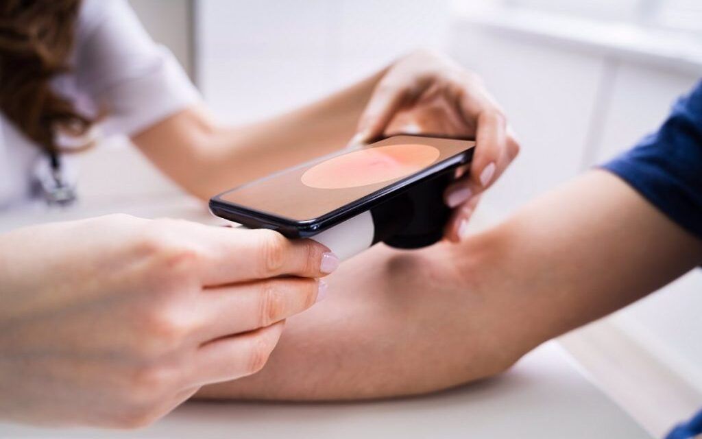 Una prueba de sangre basada en genes detecta signos tempranos de recaída en melanoma