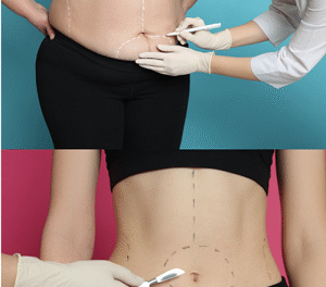 Cirugía estética: ¿puede volver la grasa tras una liposucción?