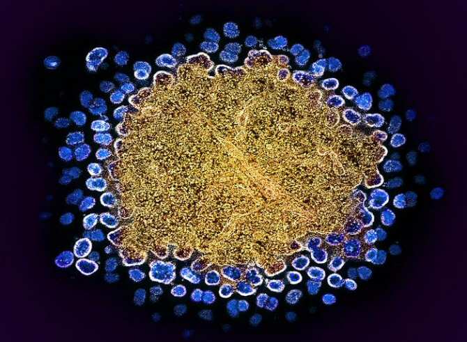 Una inyección cada 6 meses para prevenir la infección por el virus del SIDA