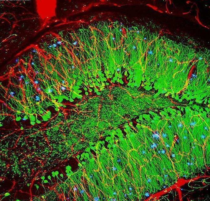 Terapia génica que podría detener la enfermedad de Alzheimer