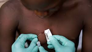UA: La epidemia de viruela del mono en África ofrece una «alentadora» tendencia a la baja en contagios