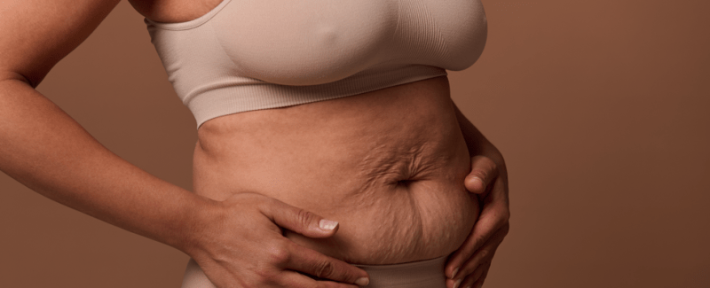 Madres renovadas: cirugía plástica después del embarazo