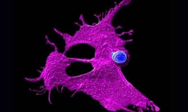 Nueva inmunoterapia contra el cáncer de páncreas
