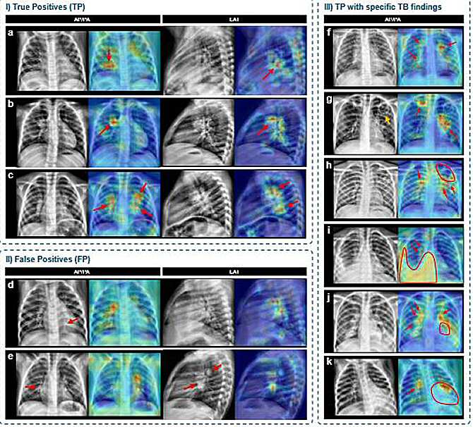 Inteligencia artificial para detectar la tuberculosis infantil