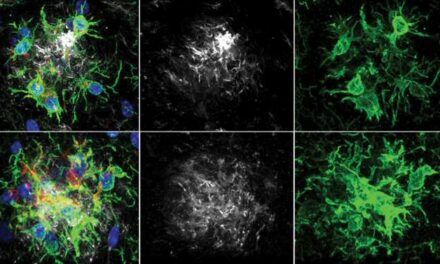 Hallan un nuevo modo de retardar el deterioro de la memoria en la enfermedad de Alzheimer