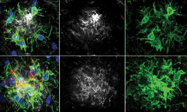 Hallan un nuevo modo de retardar el deterioro de la memoria en la enfermedad de Alzheimer