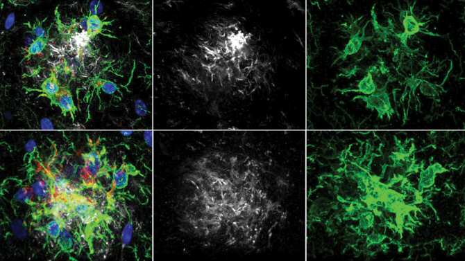 Hallan un nuevo modo de retardar el deterioro de la memoria en la enfermedad de Alzheimer