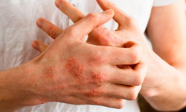 ¿Cómo evitar la dermatitis atópica?