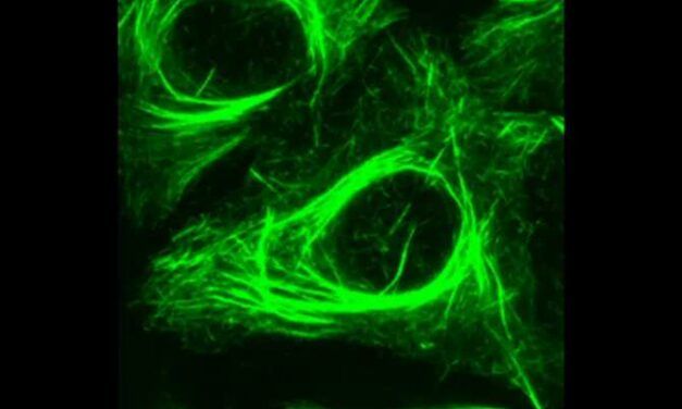 Identifican un gen relacionado con la resistencia del cáncer de próstata a una quimioterapia