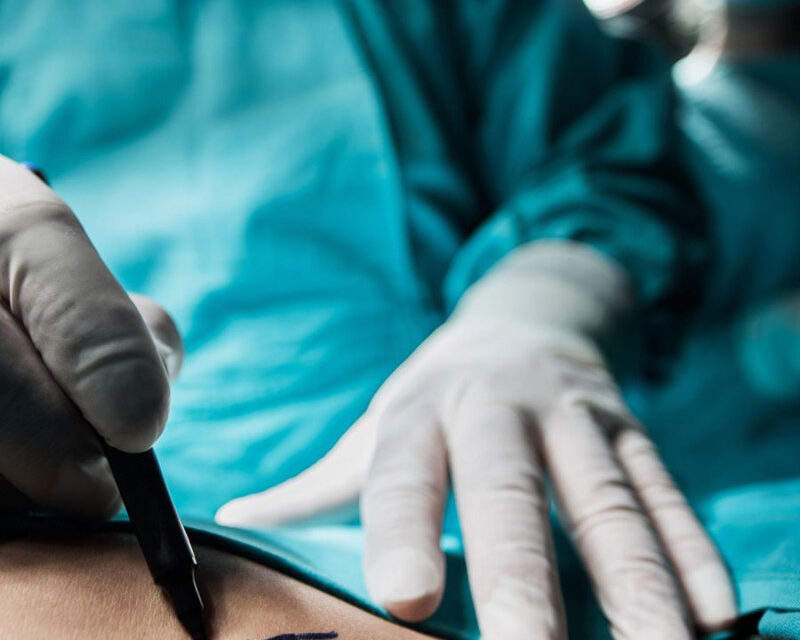 La nueva era de la liposucción: esculpir con precisión, recuperar con elegancia