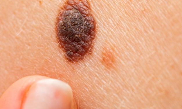 Melanoma maligno: el cáncer que en silencio va afectando la piel