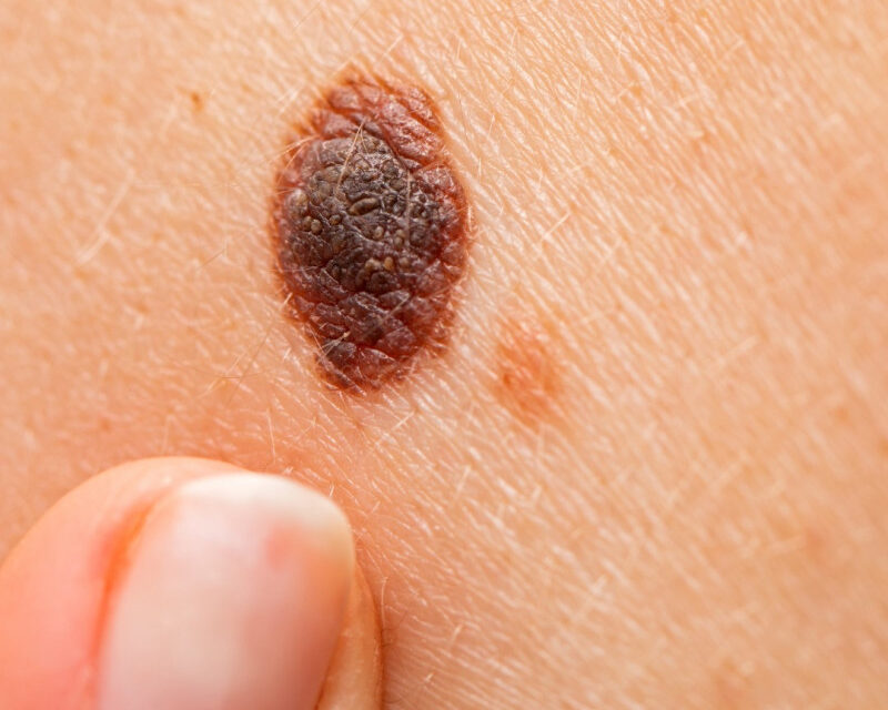 Melanoma maligno: el cáncer que en silencio va afectando la piel