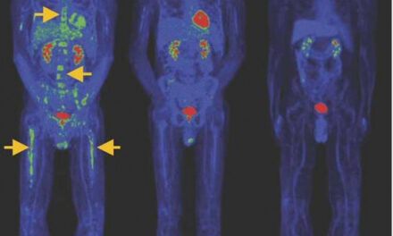 Avance clave en la terapia CAR-T contra el cáncer