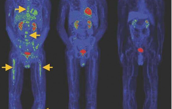 Avance clave en la terapia CAR-T contra el cáncer