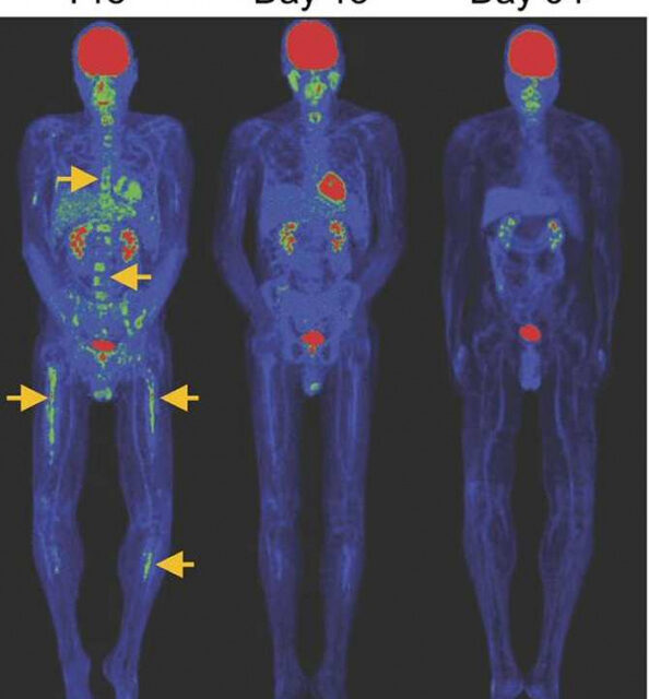 Avance clave en la terapia CAR-T contra el cáncer