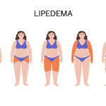 Lipedema: el cúmulo de grasa que se confunde con celulitis y que afecta a muchas mujeres