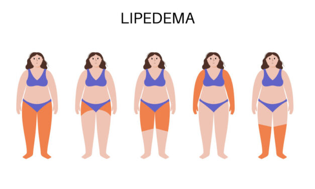 Lipedema: el cúmulo de grasa que se confunde con celulitis y que afecta a muchas mujeres