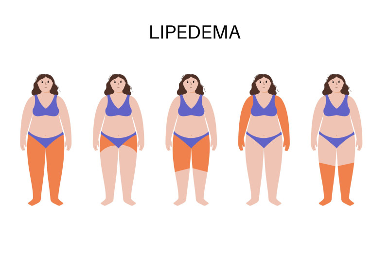 Lipedema: el cúmulo de grasa que se confunde con celulitis y que afecta a muchas mujeres